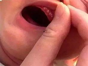 小孩吃瓜过敏嘴巴红,家长需警惕食物过敏反应